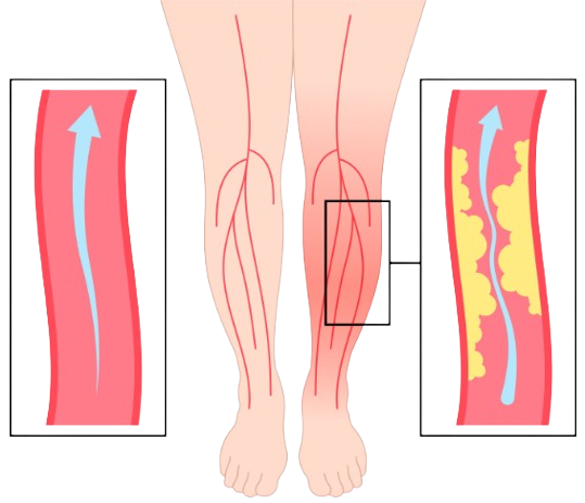 Angioplasty and stenting are minimally invasive procedures used to open narrowed or blocked arteries. A balloon is inflated to widen the artery (angioplasty), and a stent is inserted to keep it open, improving blood flow and reducing symptoms of conditions like Peripheral Artery Disease (PAD).