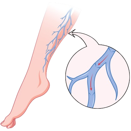 Deep Vein Thrombosis (DVT) is a condition where a blood clot forms in a deep vein, typically in the legs. It can cause pain, swelling, and lead to serious complications if not treated, such as a pulmonary embolism. Early diagnosis and treatment are essential for preventing risks.