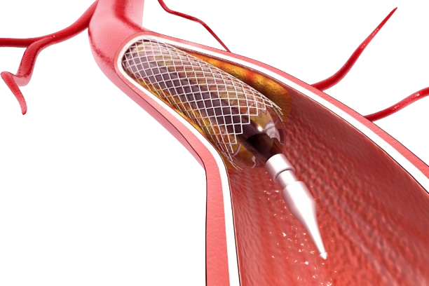 Peripheral Artery Disease (PAD) is a circulatory condition where narrowed arteries reduce blood flow to the limbs, often causing pain, cramping, or weakness in the legs. Early detection and treatment are crucial to prevent serious complications.