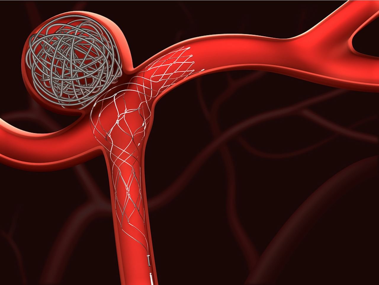 How Coiling for Brain Aneurysms Can Save Your Life