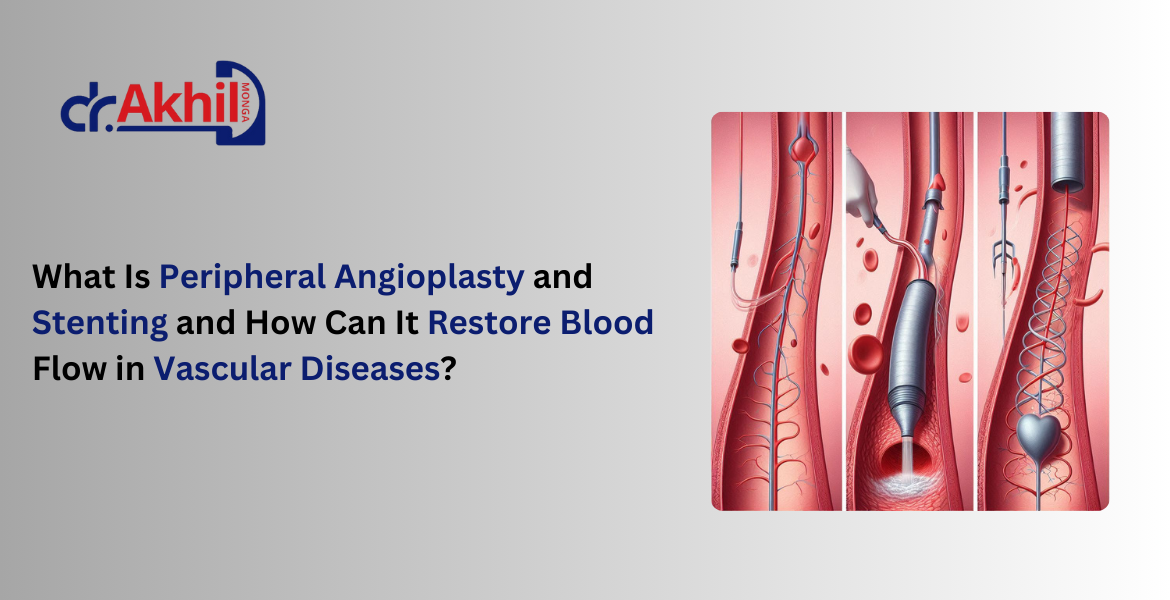 Peripheral angioplasty and stenting procedure, showing catheter insertion, balloon angioplasty, and stent placement to restore blood flow in vascular diseases.