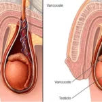 How to treat varicocele without surgery?