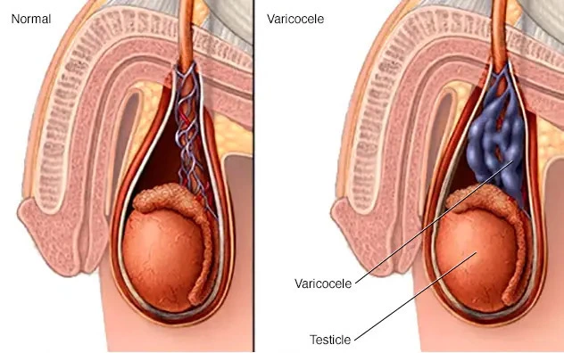 How to treat varicocele without surgery? - Dr. Akhil Monga