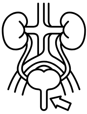 A varicocele is an abnormal enlargement of the veins within the scrotum, similar to varicose veins that occur in the legs. It occurs when the valves inside the veins in the spermatic cord fail to function properly, causing blood to pool and the veins to expand. Varicoceles can affect fertility by impairing sperm production and function, and may also cause discomfort or pain in the scrotum.