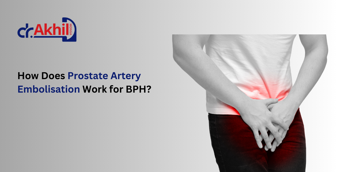 prostate-artery-embolisation-work-for-bph